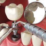 Dental Implant Surgery