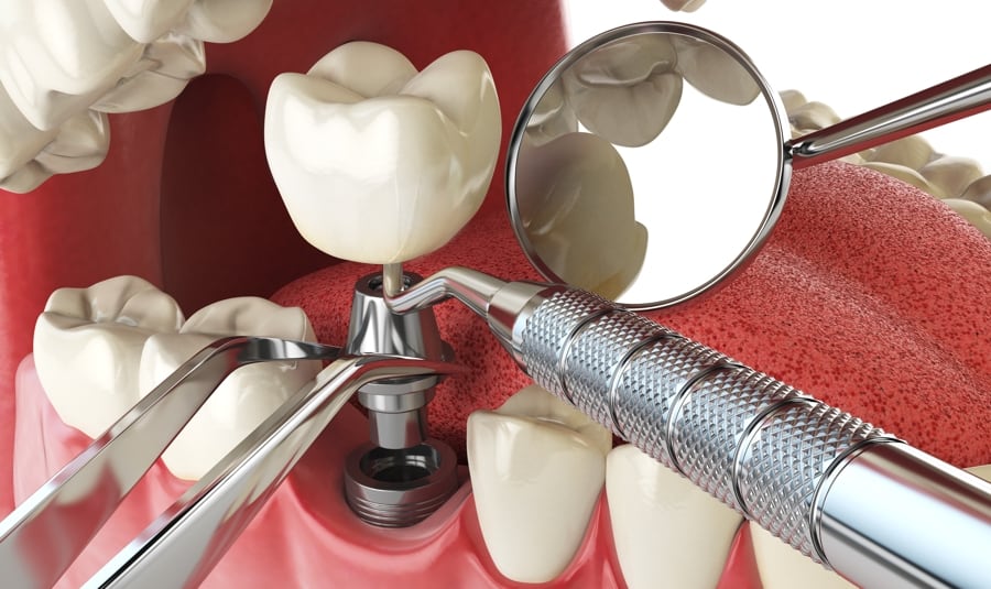 What Can You Expect from Your Dental Implant Surgery?