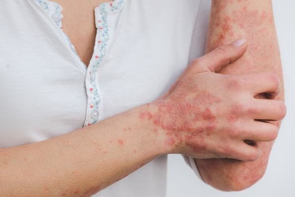 What You Need To Know About Psoriasis Flare-ups?