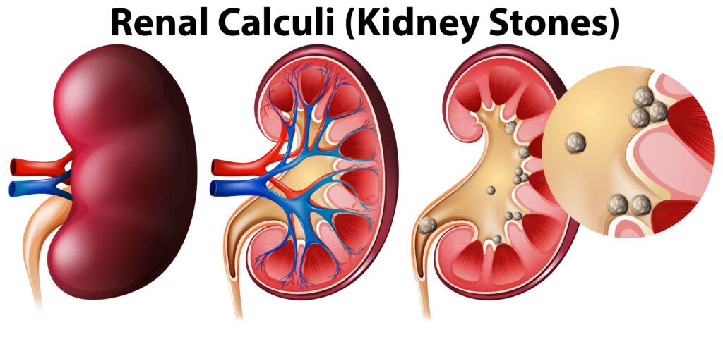 Kidney Diseases and Stone