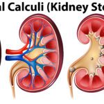 Kidney Diseases