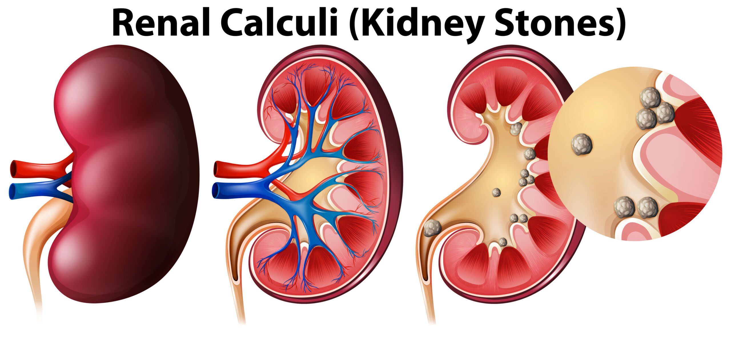 Everything You Should Know About Kidney Diseases