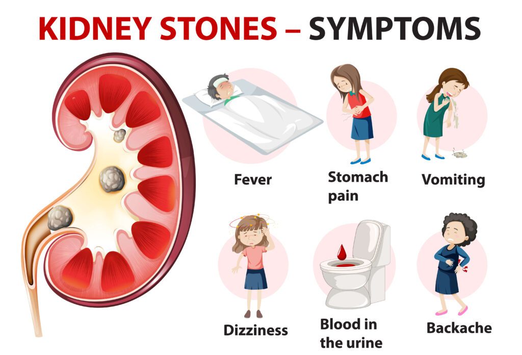 Kidney Stone Symptoms