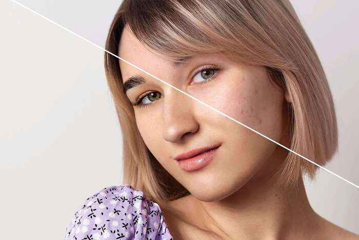 What is The Best Treatment For Acne That Works in Adults?