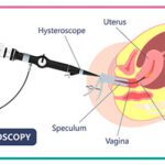 Hysteroscopy for IVF