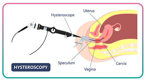 Untangling Hysteroscopy for IVF: Common Questions Answered